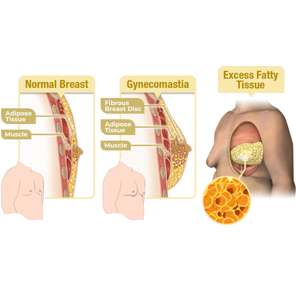 Bee Venom Gynecomastia Heating Oil